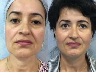 Liftingul facial cu fire de suspensie