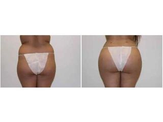 LIFTINGUL DE FESE BRAZILIAN ( FESE BRAZILIENE) Fotografii