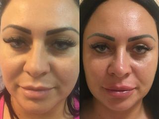 Blefaroplastia (corecția chirurgicală a pleoapelor căzute) înainte și după fotografii