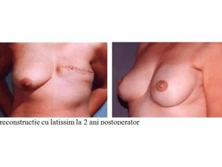 Reconstructia de san