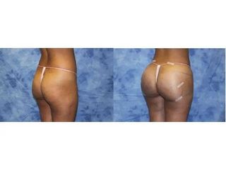 LIFTINGUL DE FESE BRAZILIAN ( FESE BRAZILIENE) Fotografii