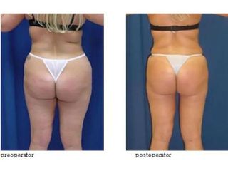 Liposucția, Lipoaspiratia, metodă chirurgicală de îndepărtare a grăsimilor
