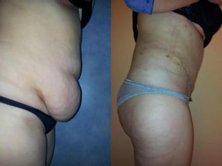 Abdominoplastie înainte și după imagine