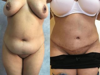 Abdominoplastie înainte și după imagine