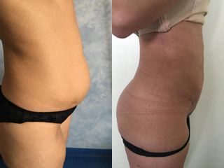 Abdominoplastie înainte și după imagine