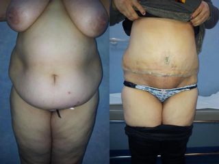 Abdominoplastie înainte și după imagine