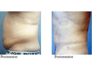Liposucția, Lipoaspiratia, metodă chirurgicală de îndepărtare a grăsimilor