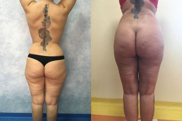 lipoaspiratie cu remodelare fese