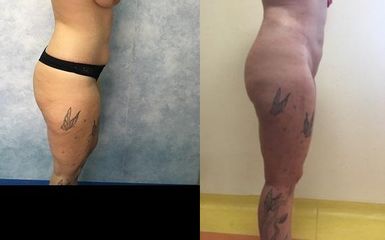 Basic liposuction