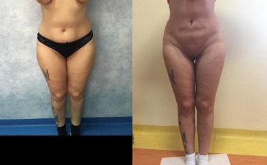 liposculptura