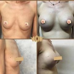 Marire sani cu implante mamare - Breast Augmentation with Implants