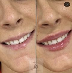 Aumento de labios - Dra. Lara Bañúls Laguía