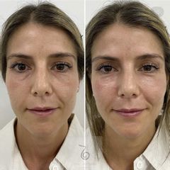 Reestructuración dinámica facial - Dra. Lara Bañúls