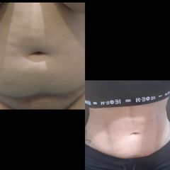 Abdominoplastia - Clínica Yenkra