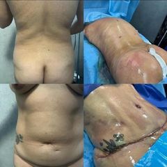 Abdominoplastia - Clínica Yenkra