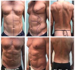 Marcación Abdominal - Clínica Yenkra