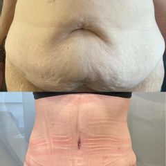 Abdominoplastia - Clínica Yenkra