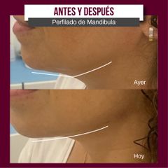 Perfilado de mandibula - Imebelle