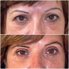 Blefaroplastia - Dr. Gorka Martinez Grau