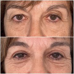 Blefaroplastia - Dr. Gorka Martinez Grau