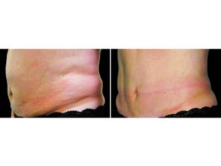 Antes y después Criolipólisis