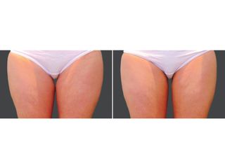 Antes y después Criolipólisis