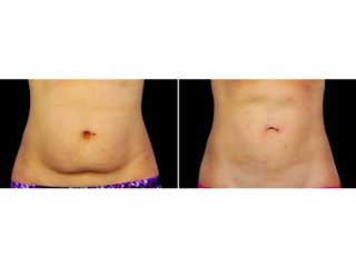 Antes y después Abdominoplastia