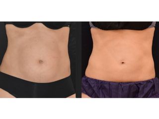 foto abdomen suzana