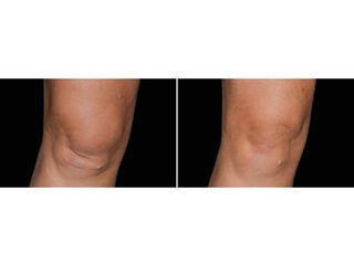 Antes y después Coolsculpting