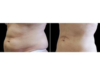 Antes y después Coolsculpting