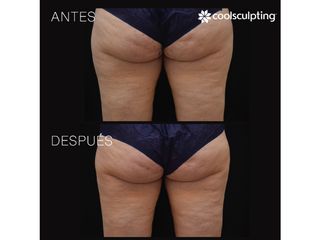 Antes y después Coolsculpting