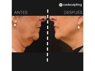 Antes y después Coolsculpting