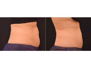 Antes y después Criolipólisis