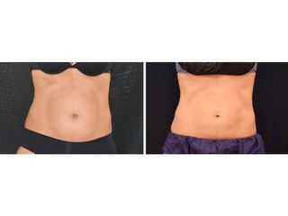 Antes y después Criolipólisis