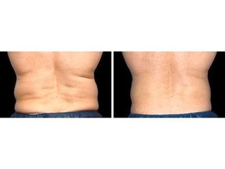 Antes y después Criolipólisis