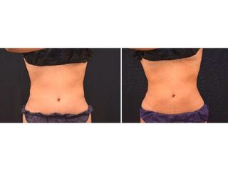 Antes y después coolsculpting 