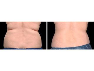 Antes y después Criolipólisis