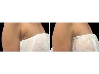 Antes y después Criolipólisis