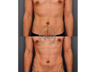 Antes y después Criolipólisis