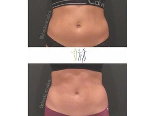 Antes y después Criolipólisis