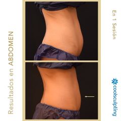Criolipólisis - Clínica Roso Rodrigues