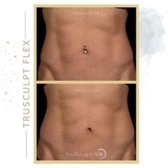 Criolipólisis - Clínica Roso Rodrigues
