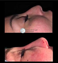 Rinoplastia - Dr. Antonio Vázquez Rodríguez