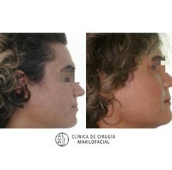 Feminización facial - Dr. Antonio Vázquez Rodríguez