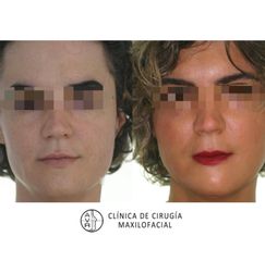 Feminización facial - Dr. Antonio Vázquez Rodríguez