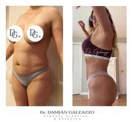 Lipoescultura - Dr. Damián Galeazzo
