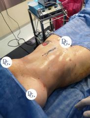 Lipoescultura RENUVION Dr Galeazzo