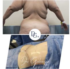 Liposucción - Dr. Damián Galeazzo
