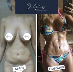 Lipoescultura - Dr. Damián Galeazzo