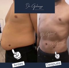 Abdominoplastia - Dr. Damián Galeazzo